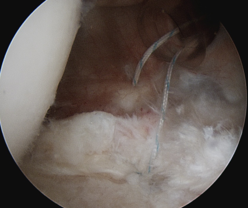 Posterior Labral Repair 2